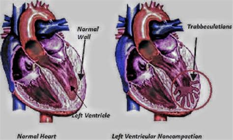 noncompaction cardiomyopathy symptoms